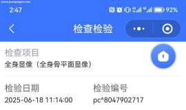 父亲肺鳞癌，cT3N0M1a，ⅣA，脑转移，每天害怕，请求在心理和治疗方面的帮助
