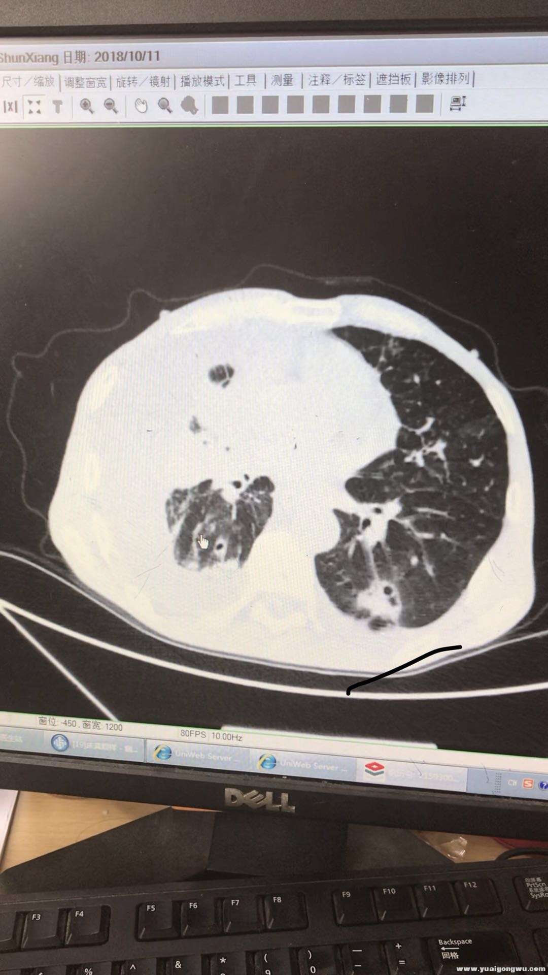 最后一次CT